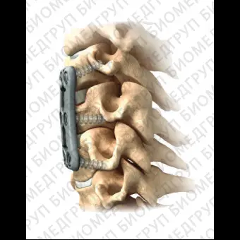 Шейная костная пластина для артродеза ACDF