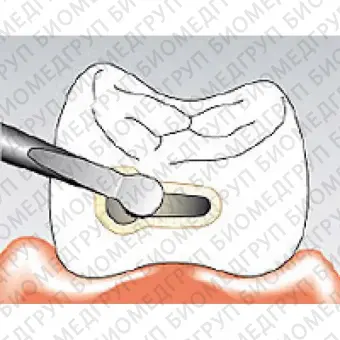 Sonicflex bevel 59 A  насадка для минимально инвазивной терапии кариеса с алмазным покрытием, дистальная