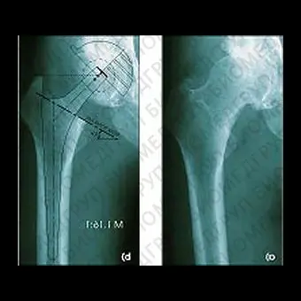 Протез бедренной кости без цемента VektorTITAN