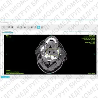 Медицинское программное обеспечение TeleStroke