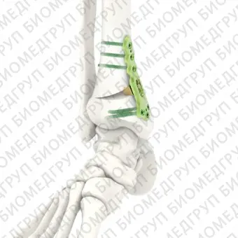 Костная пластина для остеотомии большеберцовая кость ARIX 3.5