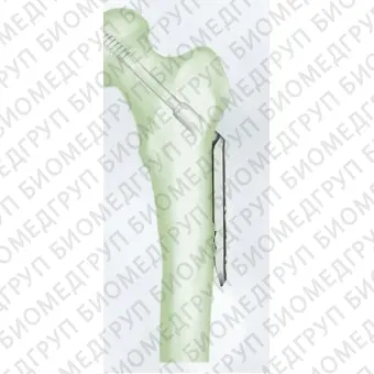 Компрессионная костная пластина для головки бедренной кости DHS