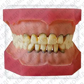 Модель верхней и нижней челюстей с 32 модельными зубами для лечения пародонтоза