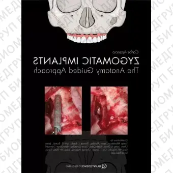 Книга Скуловые имплантаты. Анатомический подход / Под редакцией Карлоса Апарисио