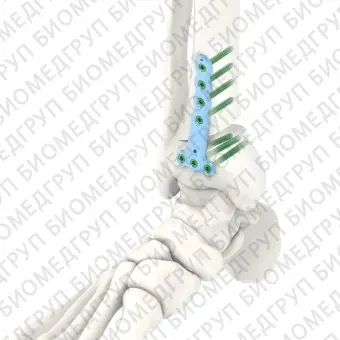 Костная пластина для остеотомии большеберцовая кость ARIX 3.5
