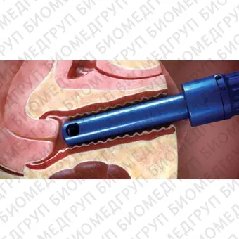 Лазер для гинекологической хирургии FemTouch